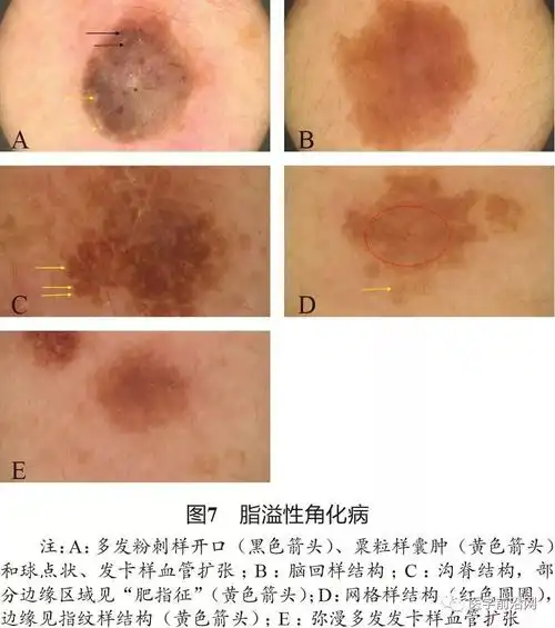 面部常见皮肤病皮肤镜诊断专家共识转载