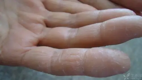 【请教】真菌性皮炎?