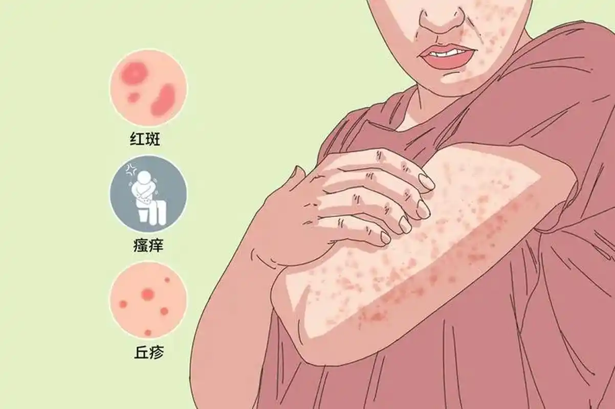 夏季皮炎又称"夏令皮炎",是一种季节性皮肤病,常在每年的6-8月份发生.