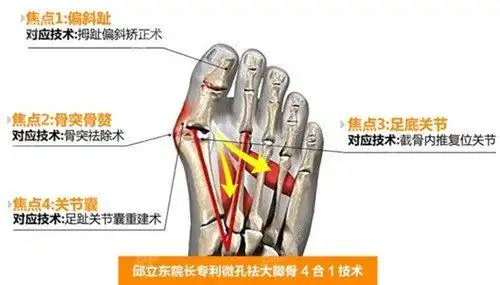 大家都知道关于大脚骨手术,有好多医院是做不了的.
