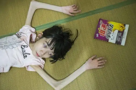 女孩瘦的皮包骨头,名副其实的骷髅人,看着就特别吓人,可是即便女孩