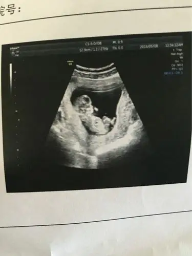 怀孕12周,与宝宝的第一次近距离接触,好感动!