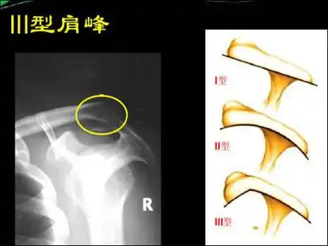 肩袖损伤的诊断和治疗