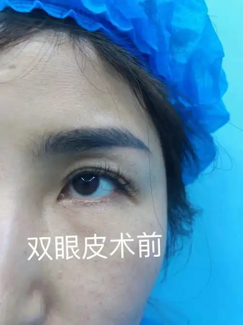 双眼皮手术前后对比