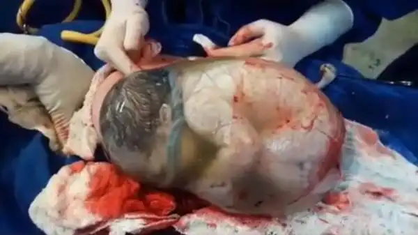 「羊水」可恒温,供胚胎养分 医:没破有什麼好稀奇?