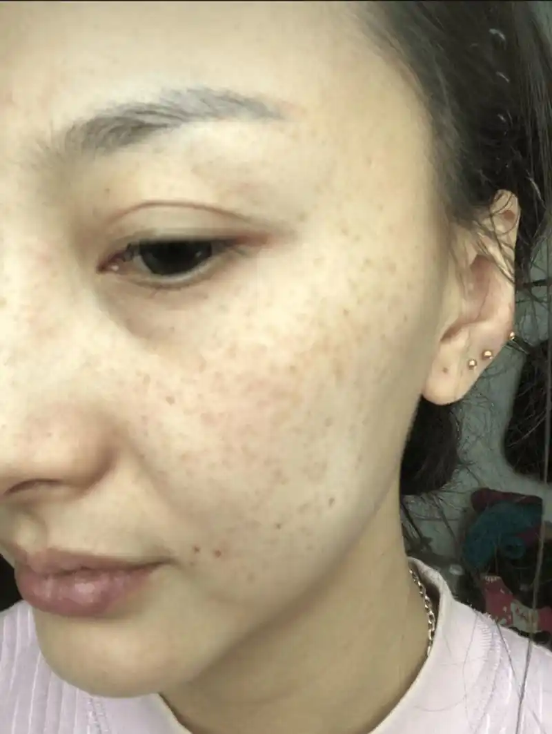 怎样预防长斑?应该如何护肤?一起来了解下吧!