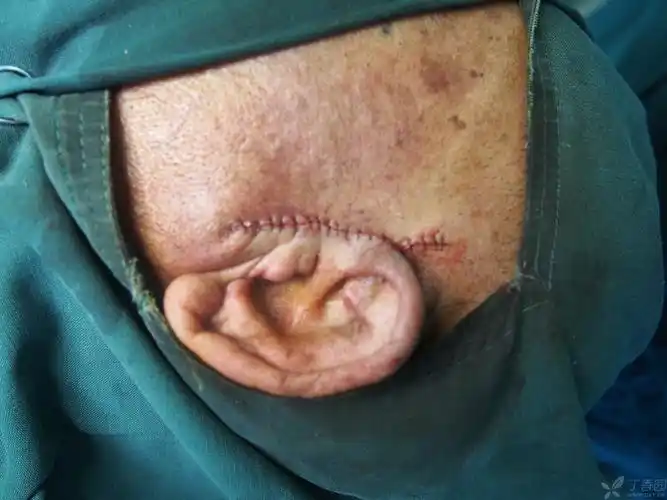 【讨论】耳廓皮肤癌