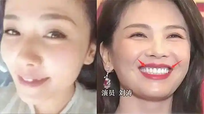 刘涛为变美拔光牙齿,花300万装上烤瓷牙,为何如今直呼太后悔?