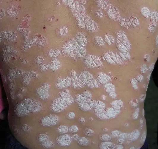 人的皮肤病种类图片