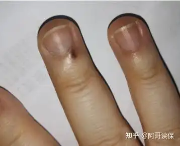 请问皮肤科门诊确诊手心有米粒大小黑色素痣,这个影响重疾险投保吗