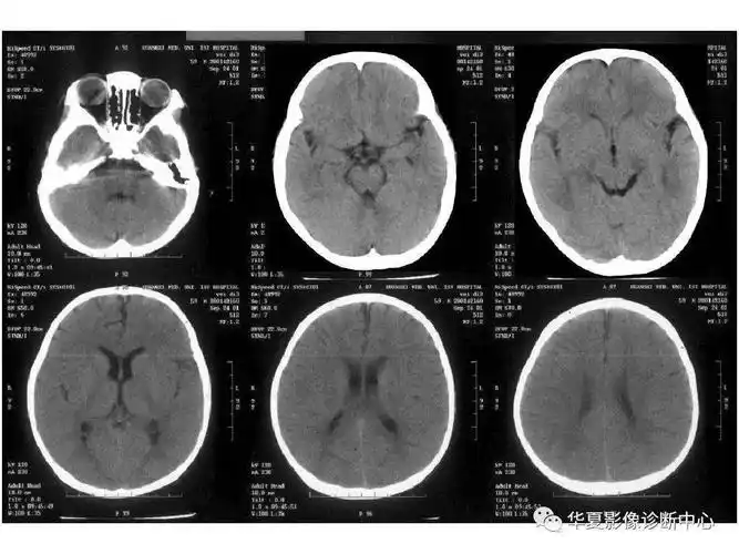 收藏!影像医生必备 | 手把手教你读懂颅脑ct