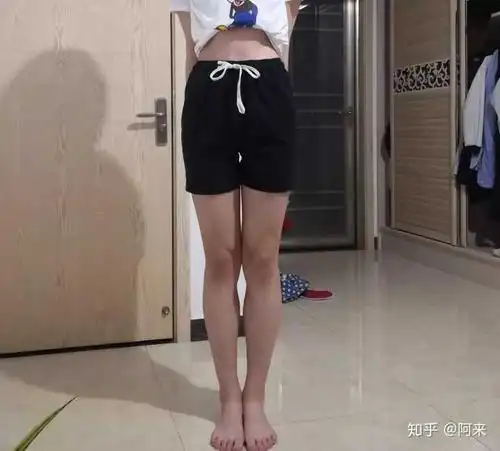 评估标准:站立时两膝并拢两脚不能并拢,这种情况叫做x型腿.