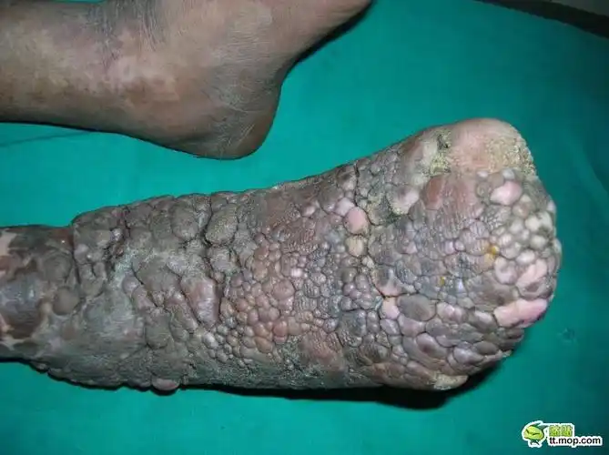 如何应对密集恐惧症?