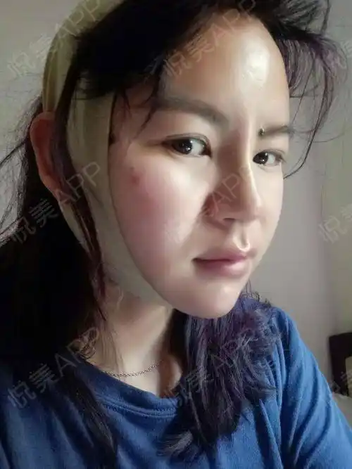 自体脂肪面部填充术后10天_面部填充术后10天_自体脂肪术后10天_纯情