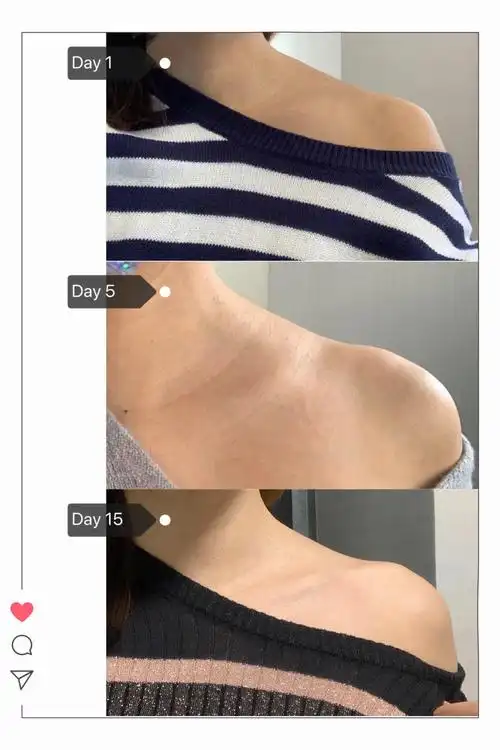 案例里的小姐姐其实上半身还算瘦,但因为斜方肌的问题(而且还高低肩)