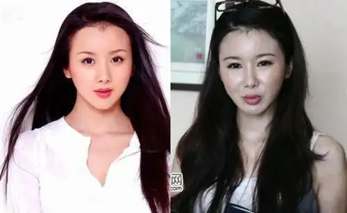 孙菲菲整容后遗症而哪些网红却越来越像明星