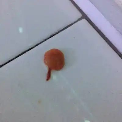 怀孕第四个月了,上厕所时发现尿出来了一块像肉一样的东西,还有血,这