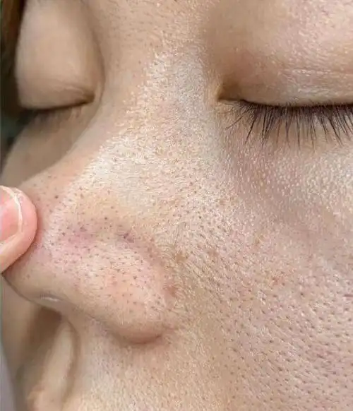 毛孔粗大的原因是什么,改善毛孔粗大的医美方法有哪些?