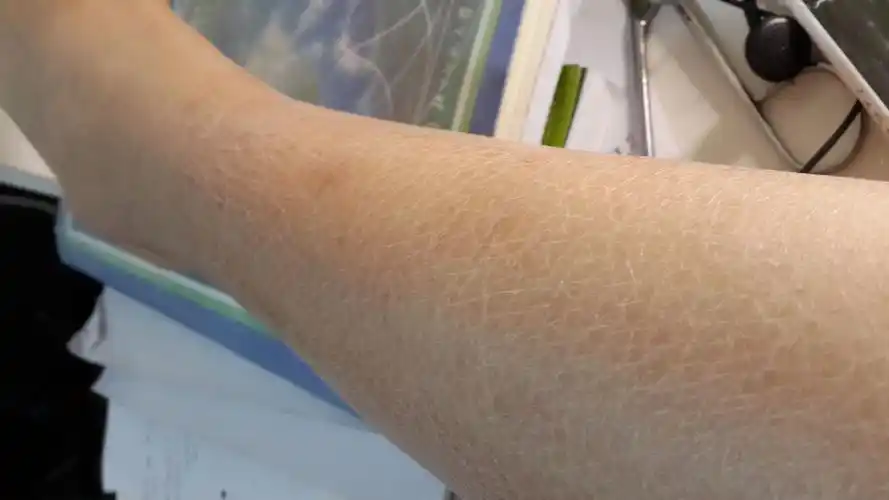 皮肤干燥有裂纹,如何改善