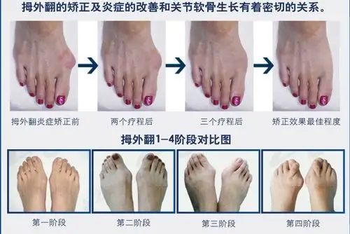 大脚趾好像是外翻的?好难看怎么办