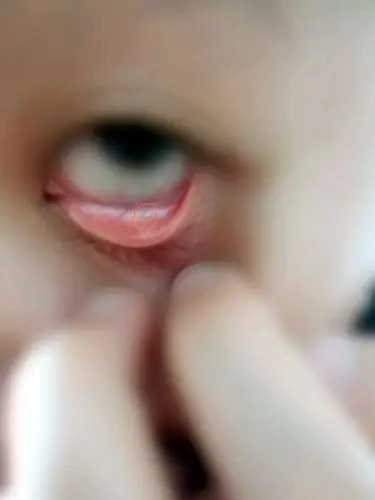 有天我戴隐形,脱下来的时候发现的,翻开左眼皮内发现有两个白点,右边