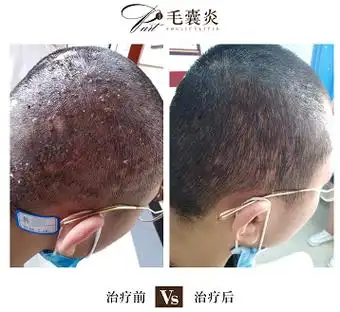 头皮毛囊炎该如何治疗效果好