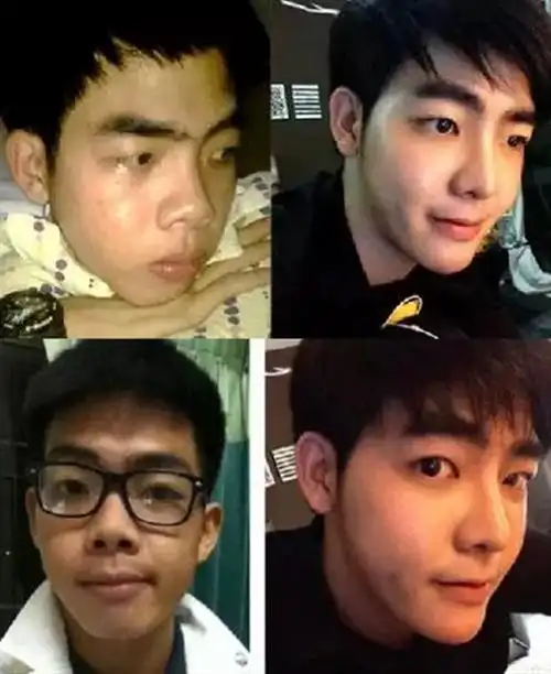 小哥花74万整容从丑男变网红