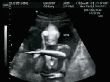 我怀孕了套路表情包:搞笑b超图_微信