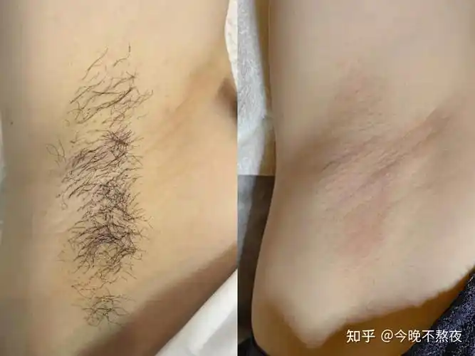 薇诗澜脱毛膏脱腋下毛会有刺痛感吗