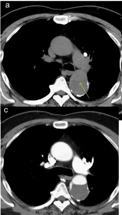 经典图谱ct平扫诊断主动脉夹层