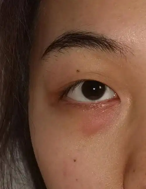 眼睛下面眼袋附近突然长红肿块