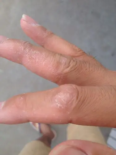 手指蜕皮,瘙痒!有4-5个月了!