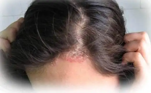 同时可以观察患者头皮的颜色和头皮屑的形状