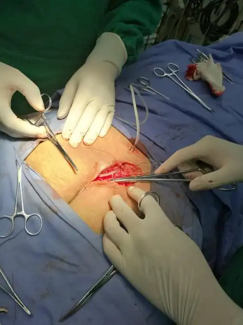 2019年8月21日双藏毛窦切除缝合术