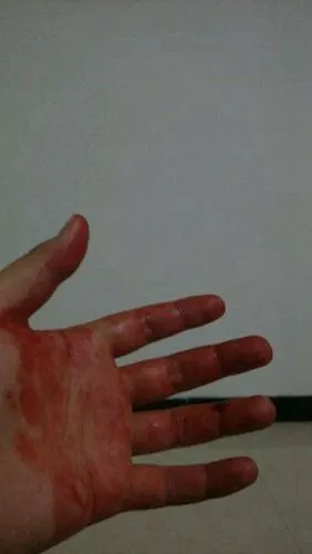 手指流血图片 (5)_有来医生