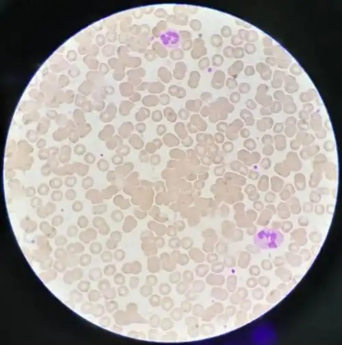 红细胞凝集天天见,你们实验室都是怎样处理的?