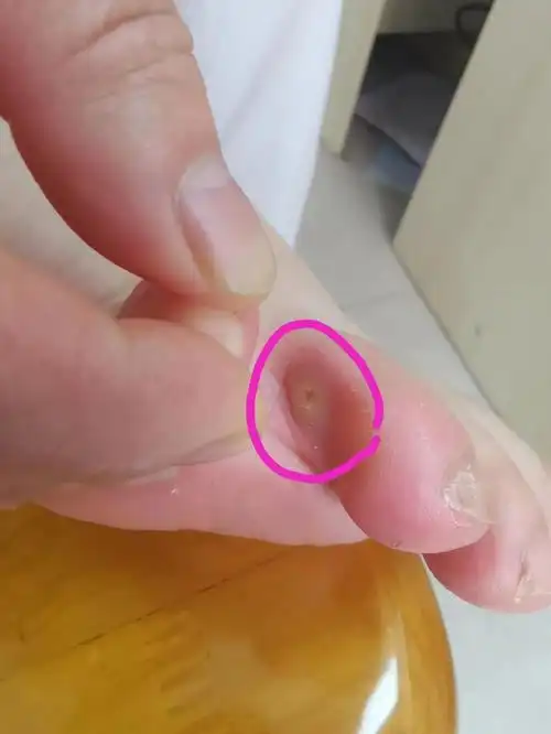 (鸡眼如何形成的)