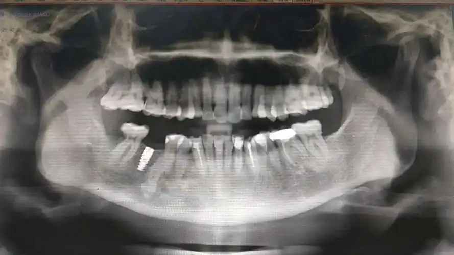 其它 我的美篇      我院自开展种植牙手术以来已经成功完成上百例