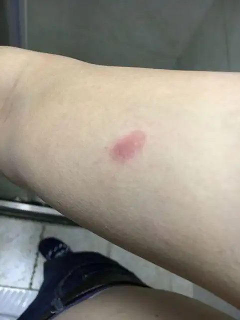 初期的皮肤癣图片_银屑病求医网