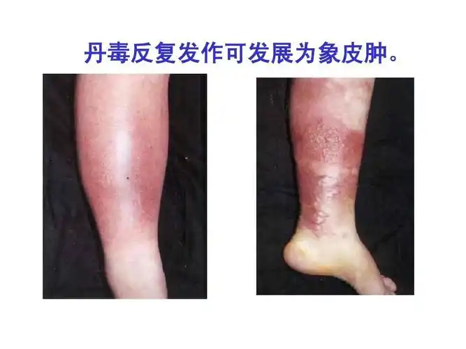 外科护理学课程-课件-5外科感染ppt