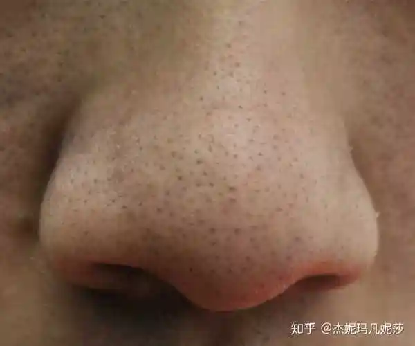 男22,混油皮,有黑头,长痘,貌似还毛孔粗大?