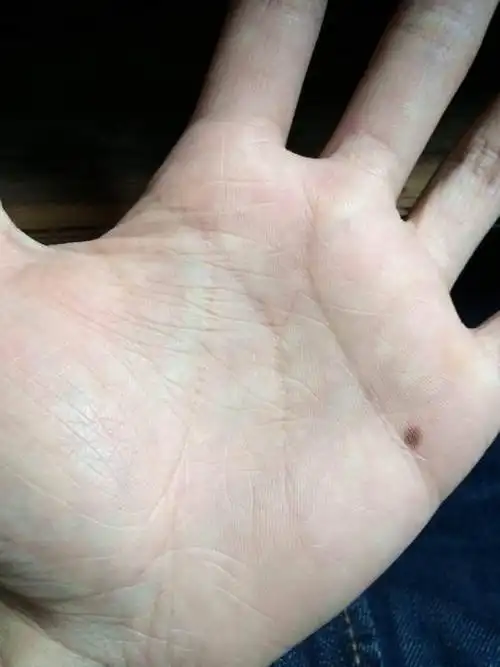 手相看手上有痣代表什么?野心?漏财?性欲?