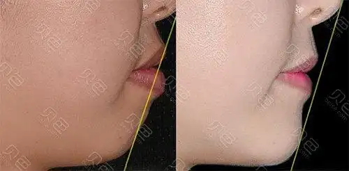 看看我拔牙矫正牙齿后脸型的变化,美了不少!