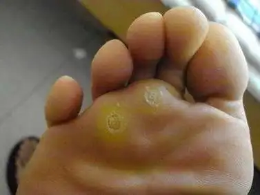 鸡眼的学名叫肉刺,由于皮损边界清楚,大小如针头或蚕豆,颜色呈淡黄或