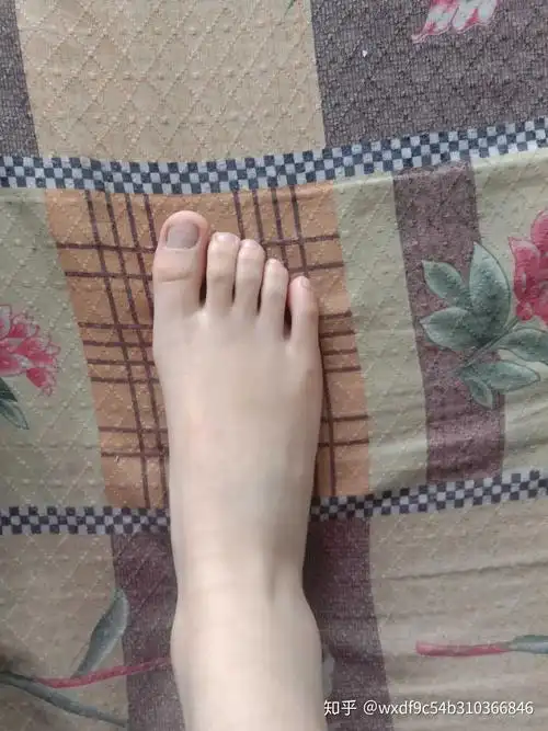 大脚趾特别长,比其他脚趾长很多的人,在现实中存在吗?