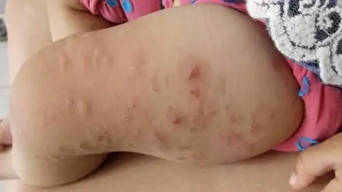 宝宝这是起的什么疙瘩.去医院看拿了好多药品都没用.期间自己没有了.