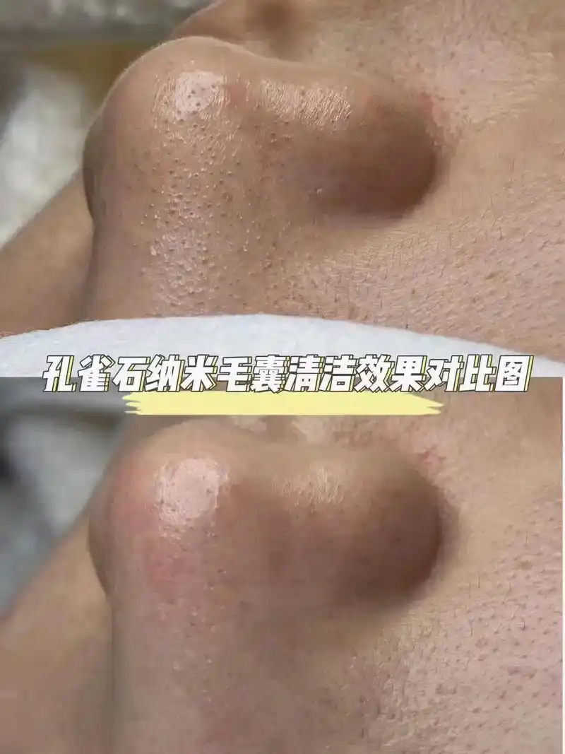 毛囊清洁术源头厂家供货.孔雀石排毒清洁套[色] 拓客季,拓客 - 抖音