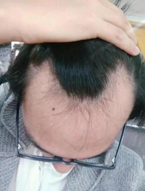 26岁雄脱3年发际线已经变成m型是先找媳妇还是治疗脱发好