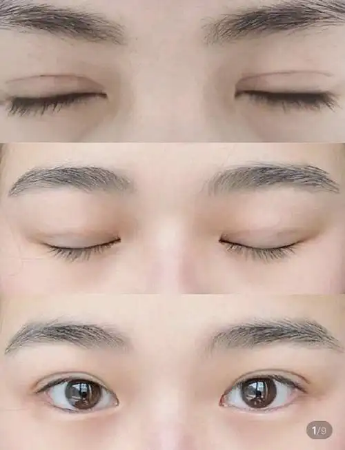 普通切开双眼皮图