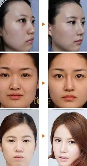 "20女子公开整容前后对比照片"中的真人秀案例出席广州美莱周年庆典